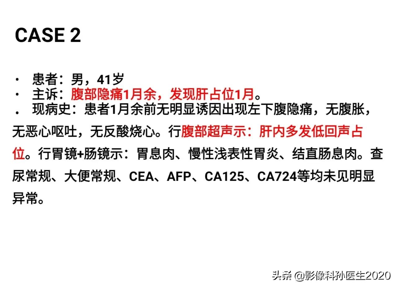 肝上皮样血管内皮瘤全国多少例,肝上皮样血管内皮瘤超声表现