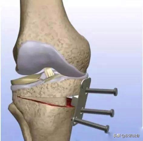 类风湿性关节炎手掌长有骨刺咋办,关节长骨刺一定是创伤性关节炎吗