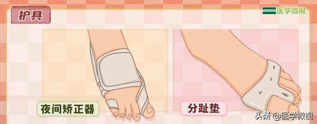 大脚骨严重畸形,大脚骨的最新治疗方法
