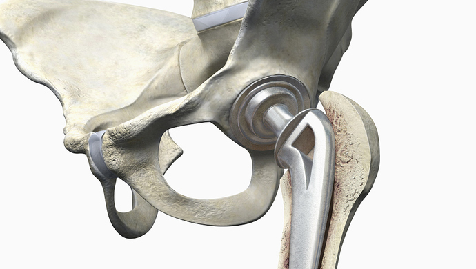 髋关节置换如何抗感染,骨科髋关节置换术后注意事项