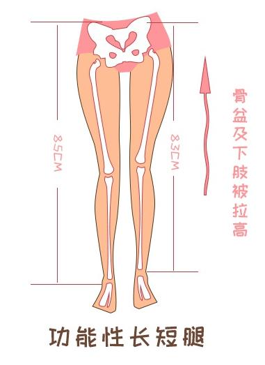 产后长短腿如何矫正,产后长短腿形成的原因和治疗方法