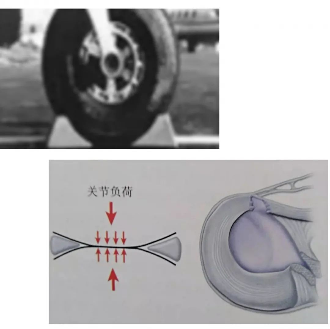 半月板损伤到底是怎么一回事,半月板后角损伤二级算严重吗