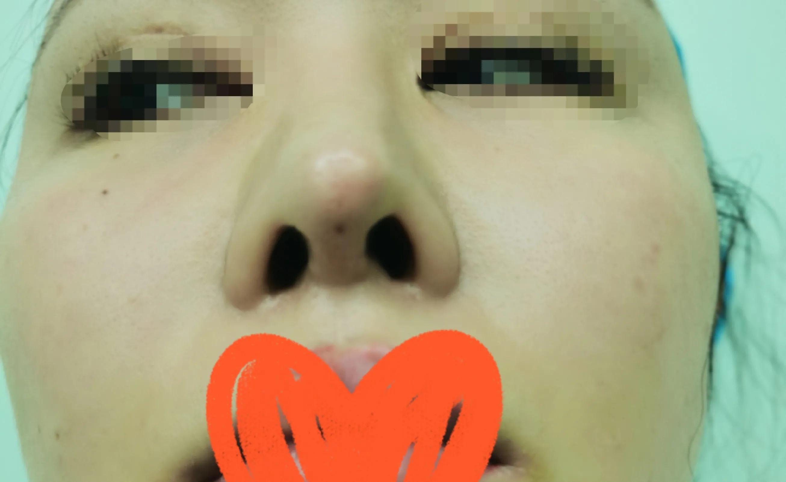 隆鼻手术怎么做视频,隆鼻手术的原理是什么