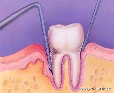 洗牙花了一千大洋,洗牙花了一千