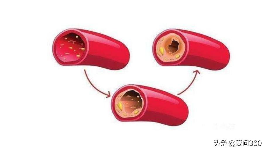 70岁老人血粘度低,老人血粘度偏高怎么调理