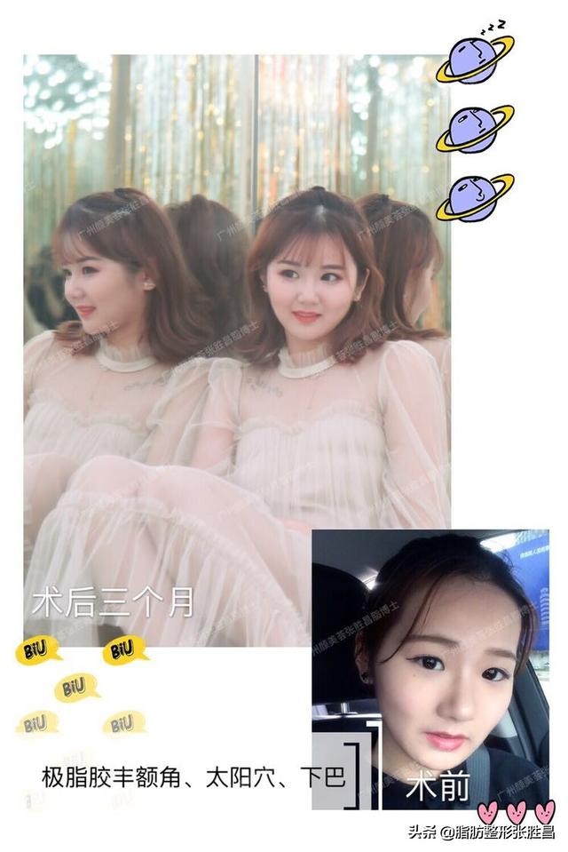 极脂胶丰额角太阳穴下巴｜22岁的自己竟比18岁的要漂亮多了