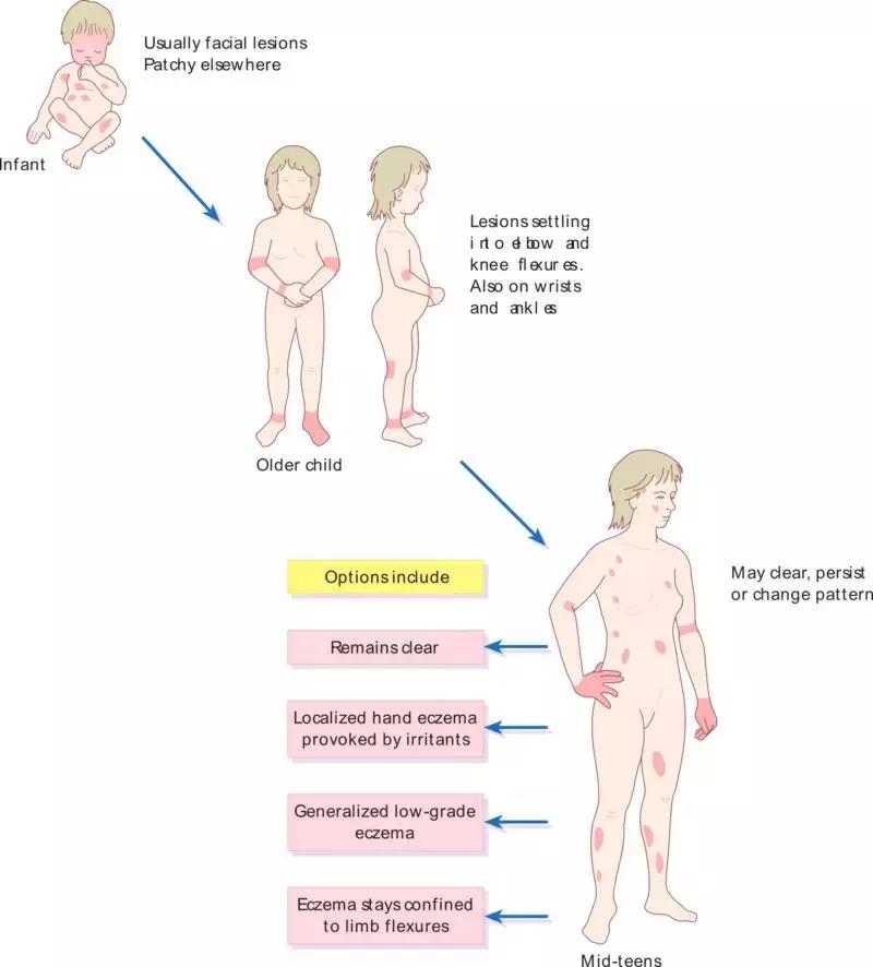 湿疹，当代老中青三代不治之症