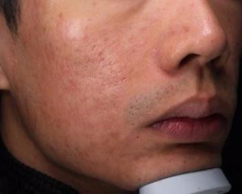 「掌健识」ALA-PDT治疗中重度*疮痤**