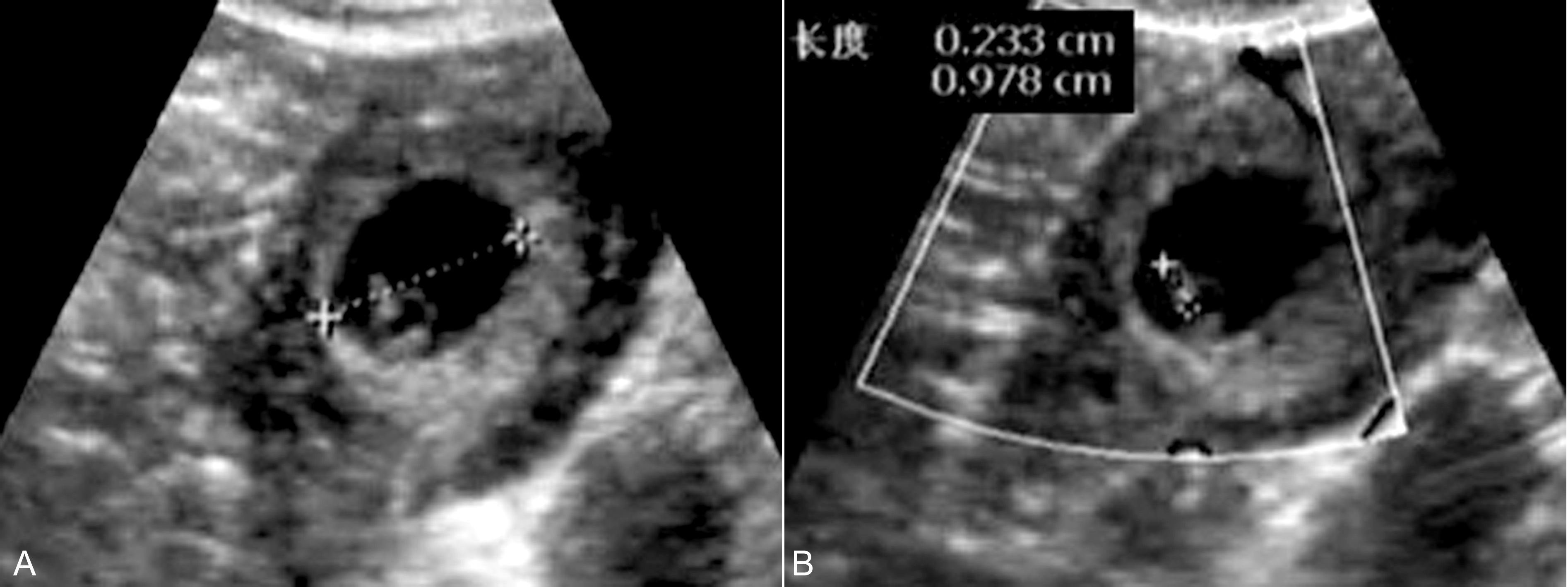 无痛输卵管超声造影全过程图解,输卵管间质部妊娠超声图像