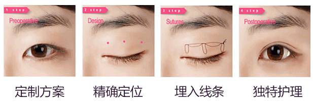 双眼皮术后长期未消肿，是失败了吗？