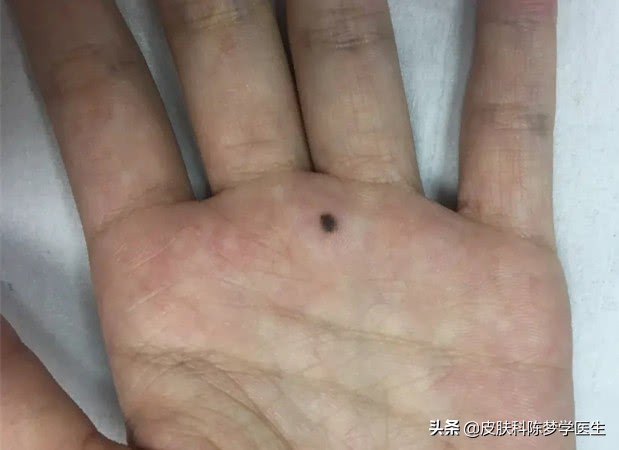 脸上长的痣如果癌变会怎样,最近身上脸上长了很多痣怎么回事