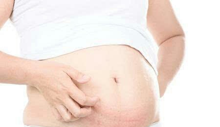 孕期肚皮痒抹什么可以缓解,孕期肚子痒有什么办法可以解决