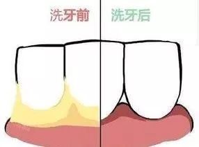 牙医眼中的洗牙竟然这么神奇,可以“包治口腔百病”
