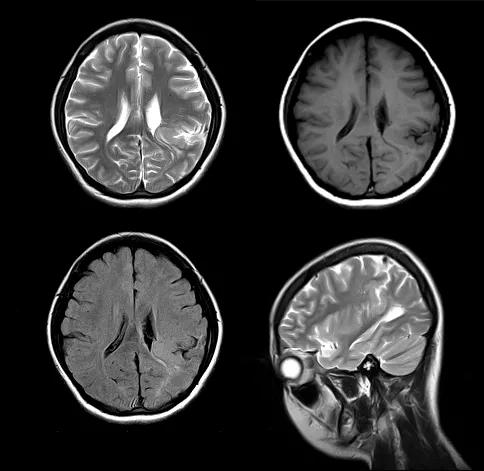 先天性颅脑发育不全,先天颅脑发育不良能治吗