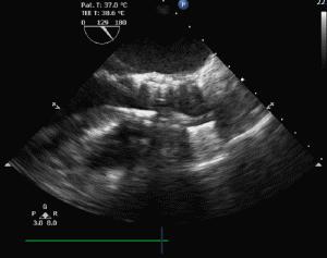 对造影剂过敏如何进行介入治疗,造影剂过敏迟发性治疗