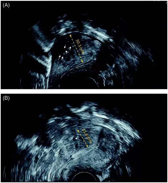 “海扶刀+针剂+避孕环”，这家医院治疗子宫腺肌症有了新方法