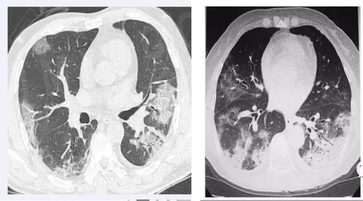 疫情儿童发热如何就诊,儿童新冠症状发热吃什么药