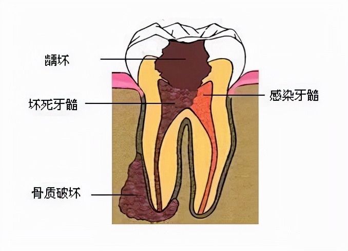牙齿烂了一大半不补可以吗,牙齿全部烂了能不做牙冠吗
