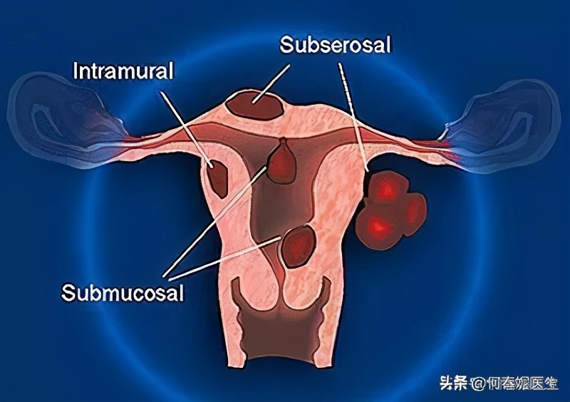 子宫肌瘤手术麻醉方式,子宫肌瘤手术需要住院几天
