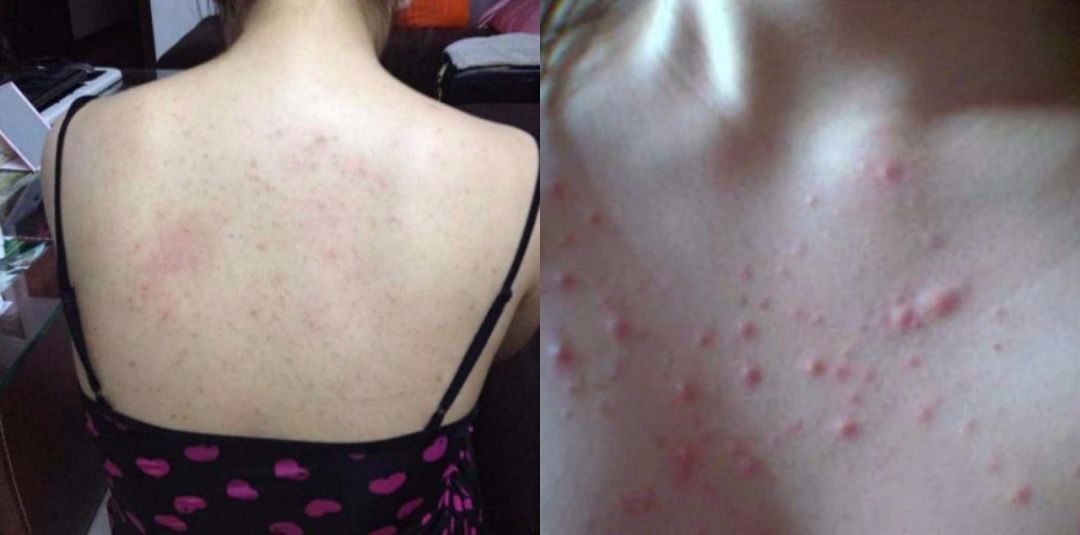 鼻子起痘都能挤出很多白色油脂,鼻子白色的痘痘挤出来有痘坑吗