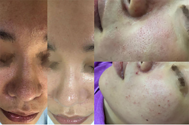 宝露斯毛孔收细套：赋活嫩滑肌肤、收缩毛孔渐平滑