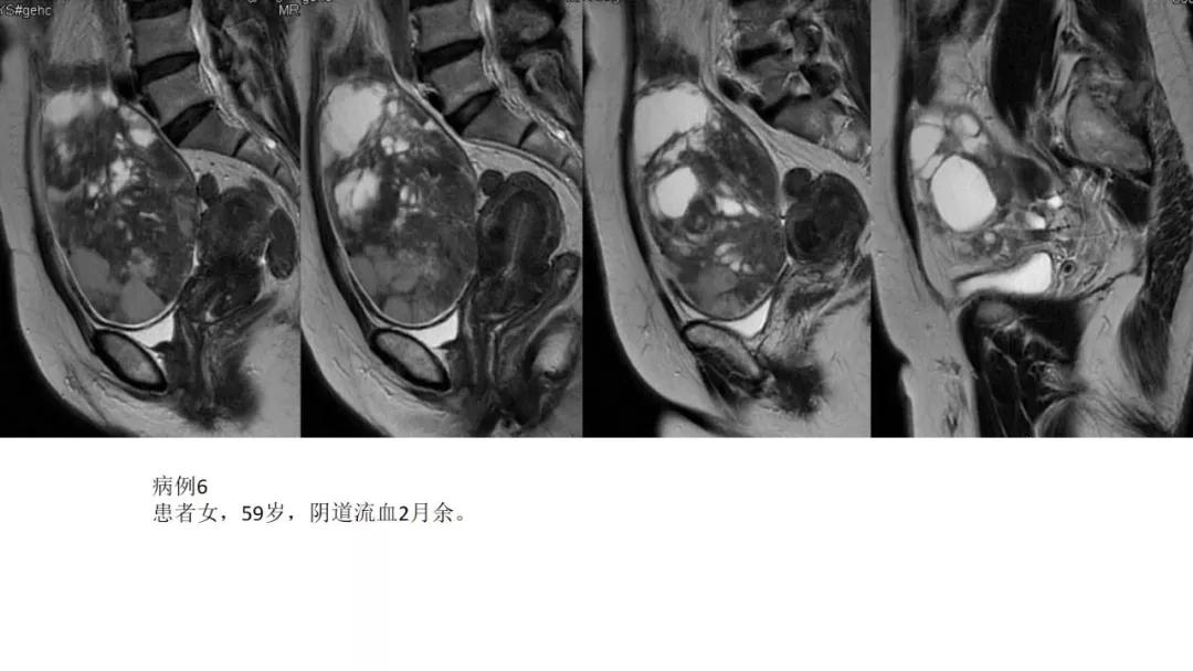 卵巢原发肿瘤的分析思路
