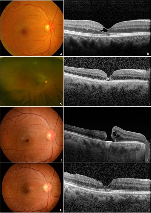 视网膜脱落玻璃体切割术后并发症,眼科黄斑裂孔病例