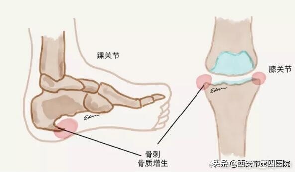 骨头里长刺严重吗,骨头长刺怎么治疗好得快