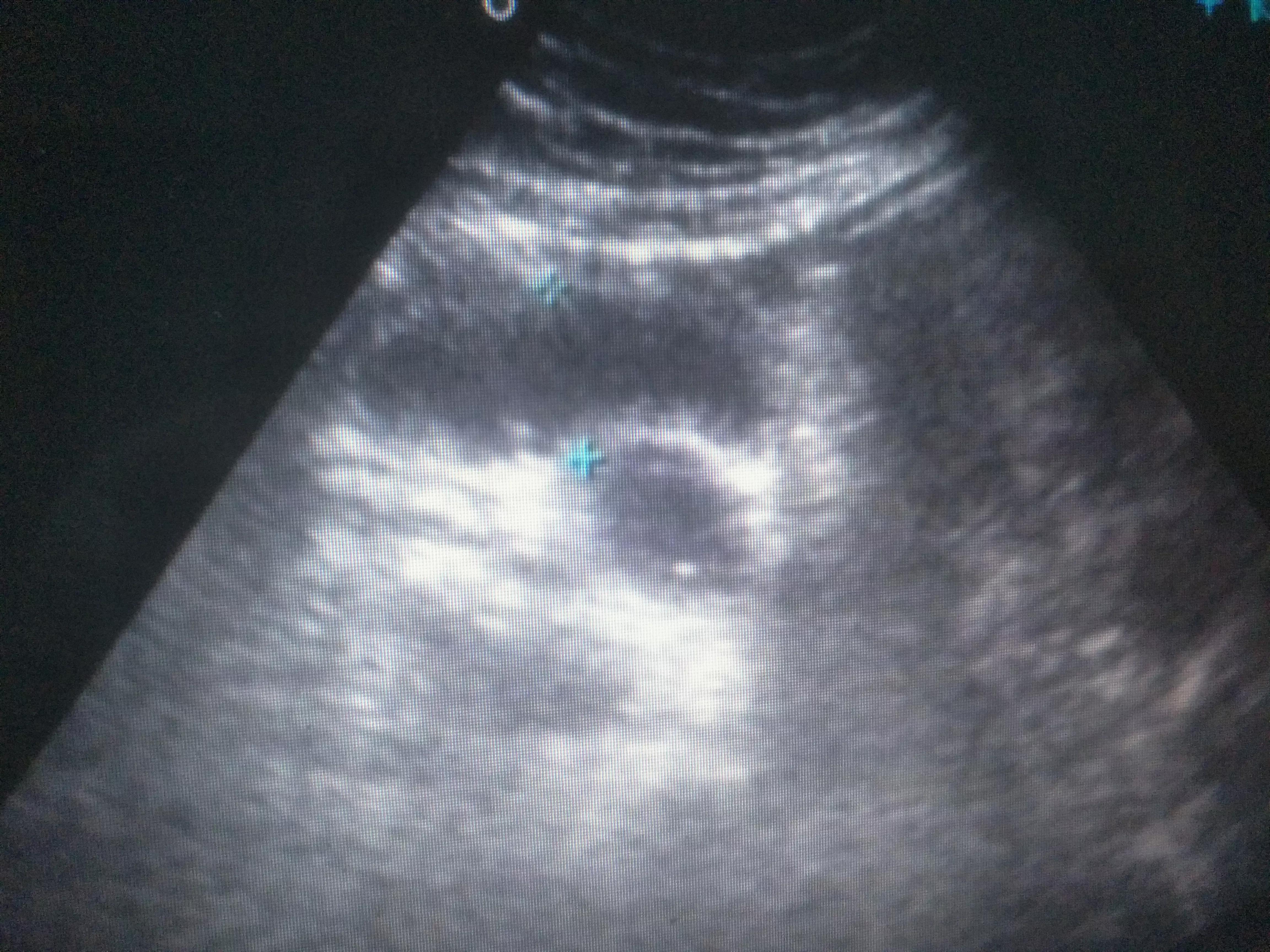 左下腹隐痛是尿道结石吗,右下腹疼痛是不是胆囊结石