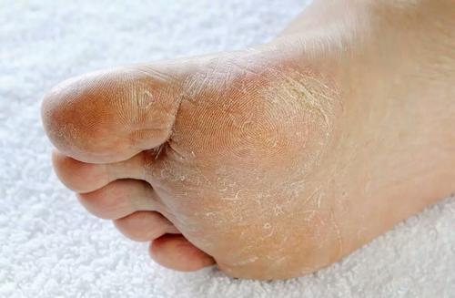 脚气如何引起,脚气病原因和防治方法