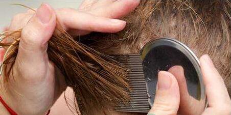 去头发虱子与虱子卵最有效方法,去除头上虱子和虱子卵最好小窍门