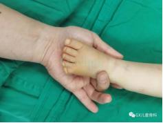 健康学堂丨多指（趾）未必多福！及早就诊才是最佳选择