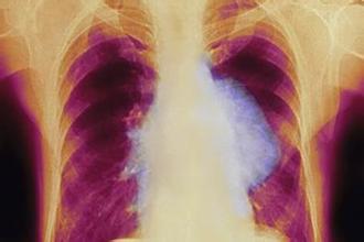 肺癌产生的恶性胸水能治好吗,肺癌腺癌并有胸水怎么治疗