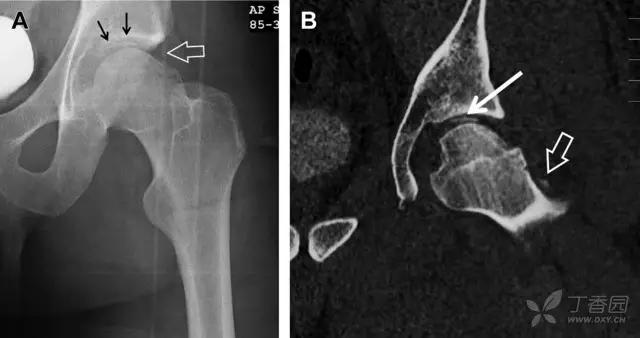 值夜班急救措施,放射科容易漏诊的骨折