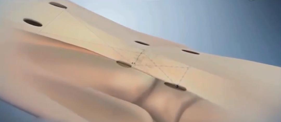 跟腱自发性断裂,跟腱断裂全负重行走