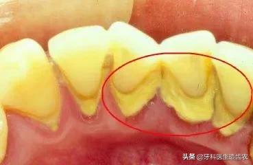 美白牙齿去牙结石电动牙刷,欧乐b电动牙刷可以刷掉牙结石吗