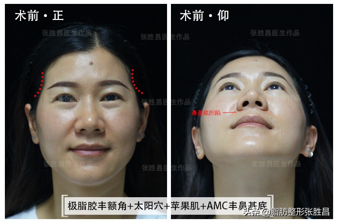 自体脂肪除皱是怎么样的,自体脂肪除皱的优点缺点有哪些