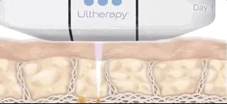 张雨绮说做超声刀就像在烤肉?我去体验了一把……