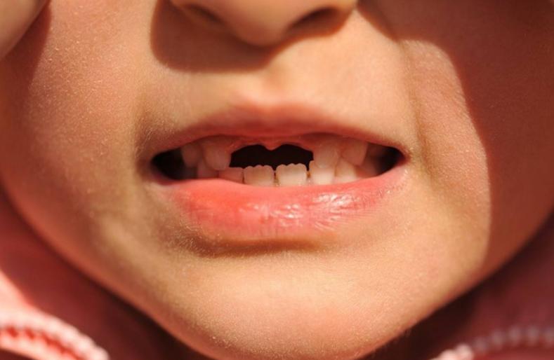 孩子乳牙别扔掉关键时能救命,乳牙千万不要硬拔