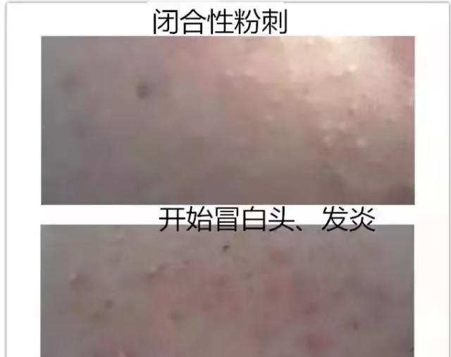粉刺没挤干净在皮下闭合怎么办,挤闭合粉刺