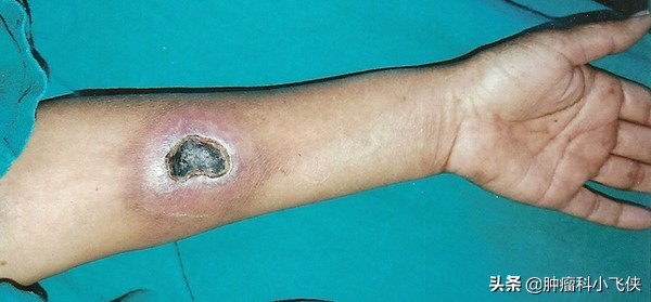 化疗埋管保证治疗顺利进行，一旦药物外渗患者遭罪又耽误治疗