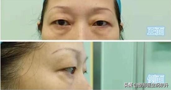 上睑下垂手术和割双眼皮的区别,上睑提肌手术必须要割双眼皮吗