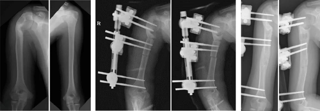 小儿骨科矫正足内翻,宝宝足内翻矫形支具