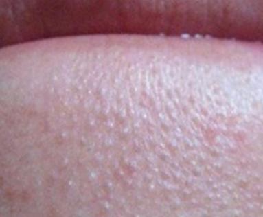 反复长闭口红痘痘怎样调理,满脸闭口痘痘怎么调理