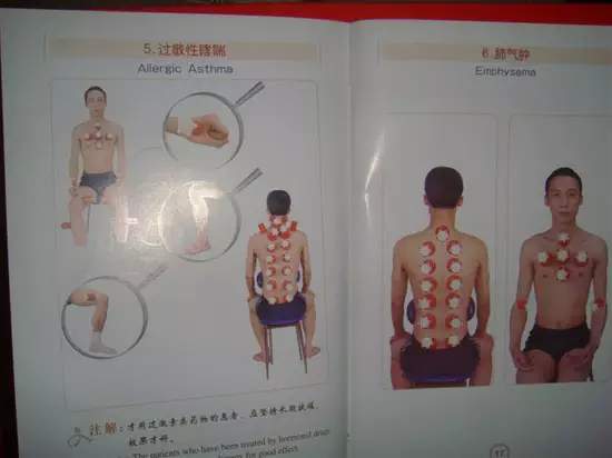 拔罐有哪些穴位图解,最全拔罐穴位疗法图解