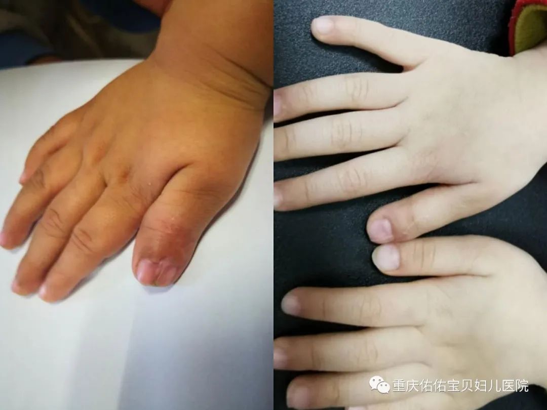 孩子出现多指畸形该怎么办,宝宝脚趾畸形多指最佳治疗时间