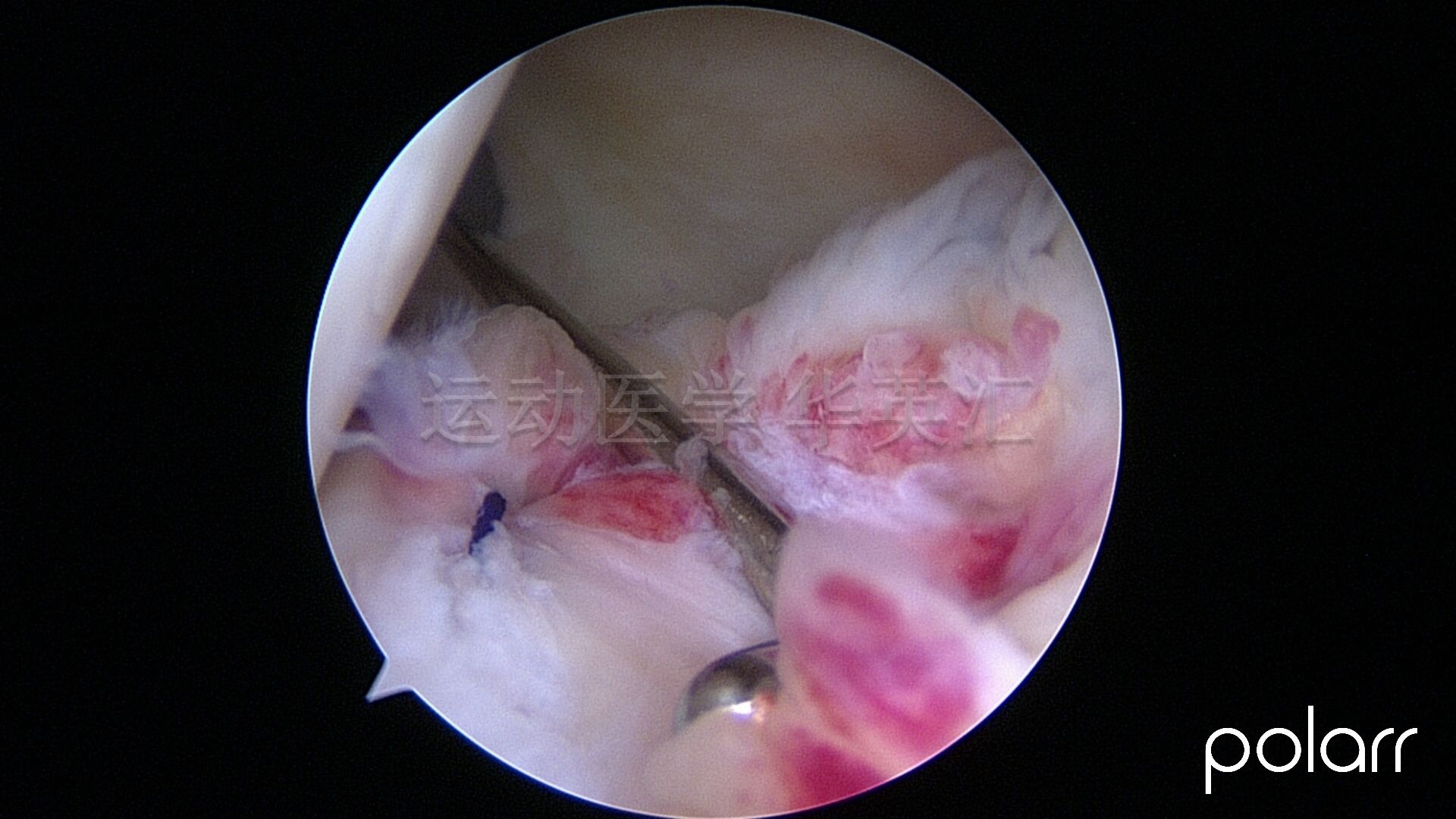 前交叉韧带断裂十年还需要治吗,前交叉韧带1°损伤能自愈吗
