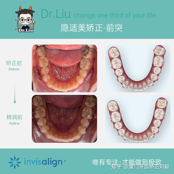 拔牙正畸矫正全过程3d,拔牙嘴凸正畸的真实案例