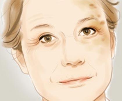 请问脸上有色斑用什么方式来处理,你脸上的斑是怎么去掉的