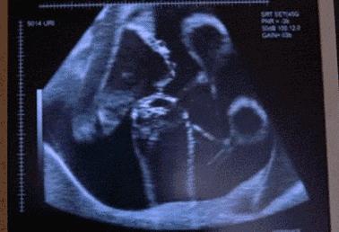 胎宝宝一般怎么动,怎么判断胎宝宝动是手还是脚动